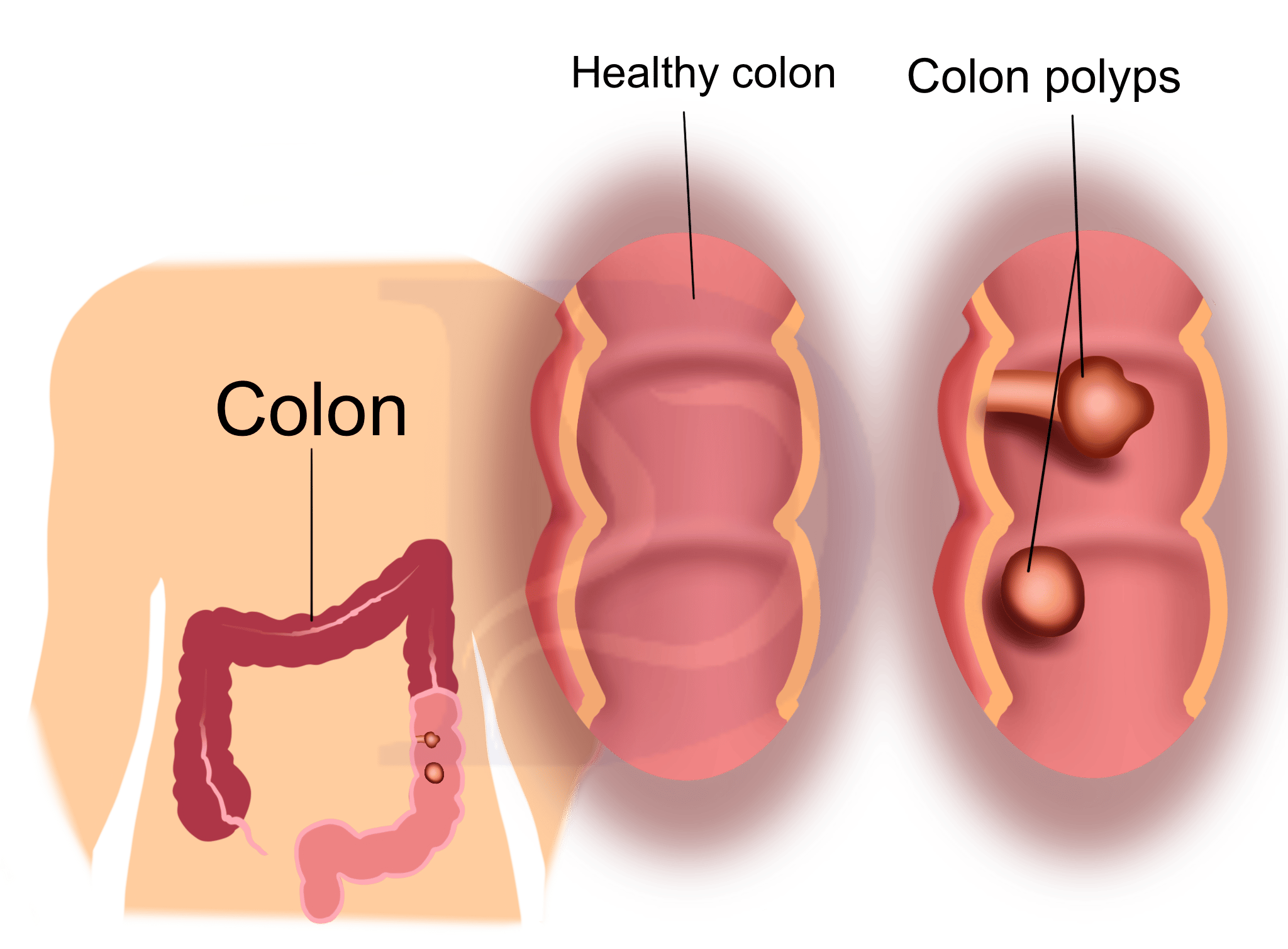 Polyps Cancer Screening Doctor in chandigarh