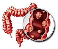 Colorectal Cancer doctors in Chandigarh