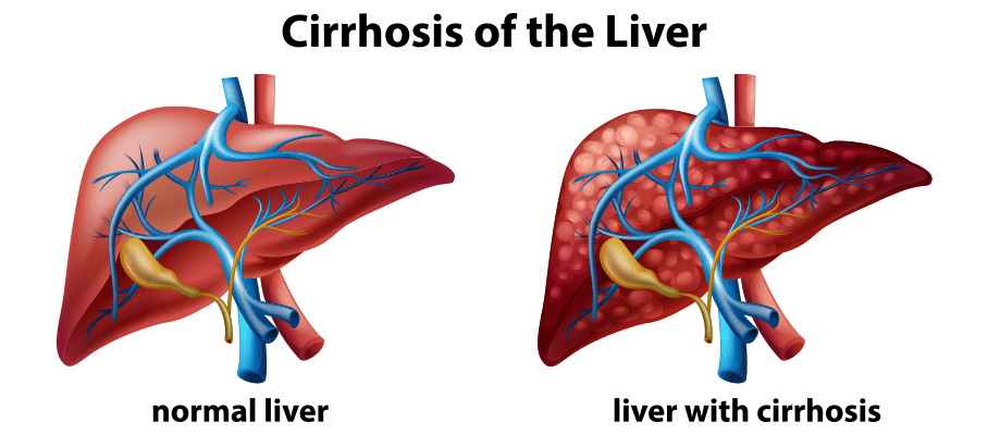 Liver Biopsy Expert in Chandigarh