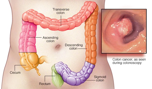 Colorectal cancer screening in Chandigarh